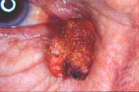 Basal Cell Carcinoma